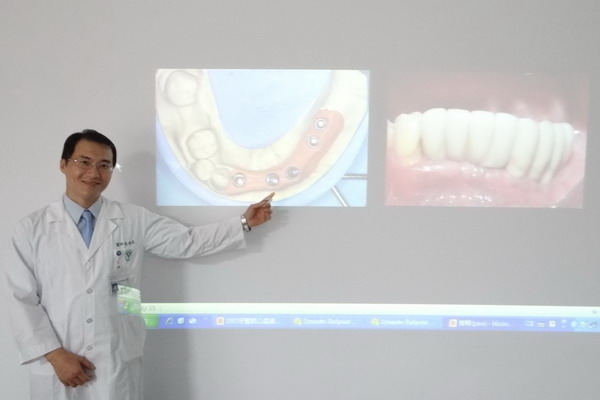 長期缺牙 影響咀嚼， 奇美醫院建議以人工植牙解決